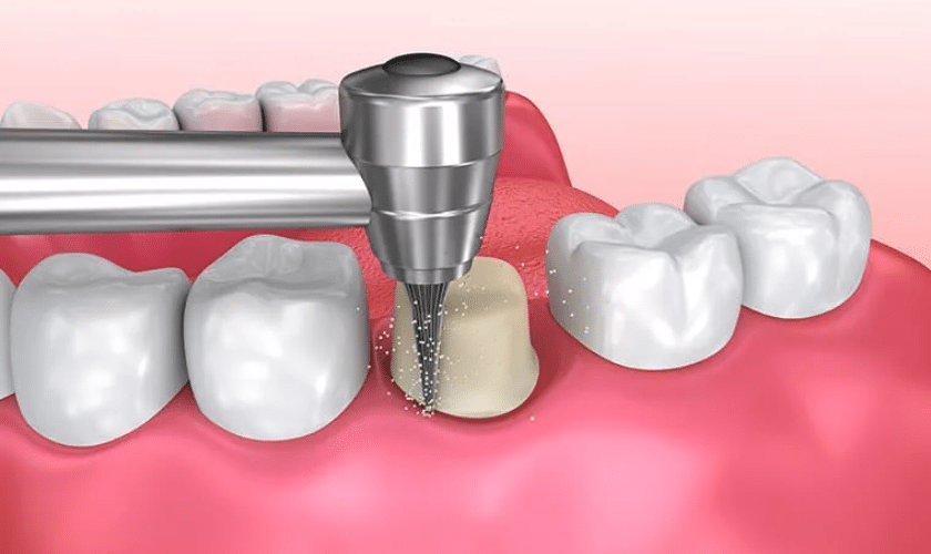 Root Canal Therapy in Las Vegas