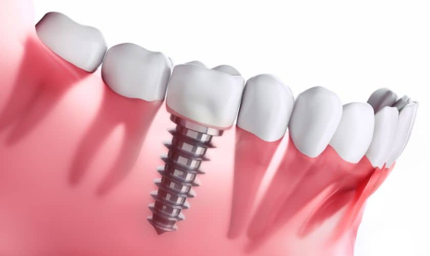 Dental Implants in Las Vegas: A Permanent Solution for Missing Teeth
