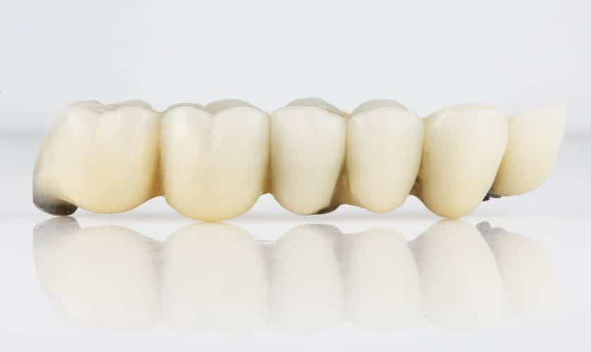 Featured image for “Dental Bridges for Front Teeth: Aesthetic Considerations”